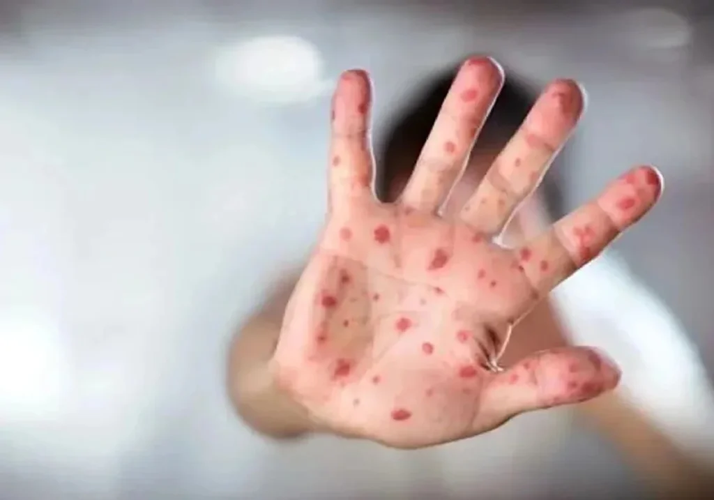 La OMS retira a España el estatus de país libre de sarampión.